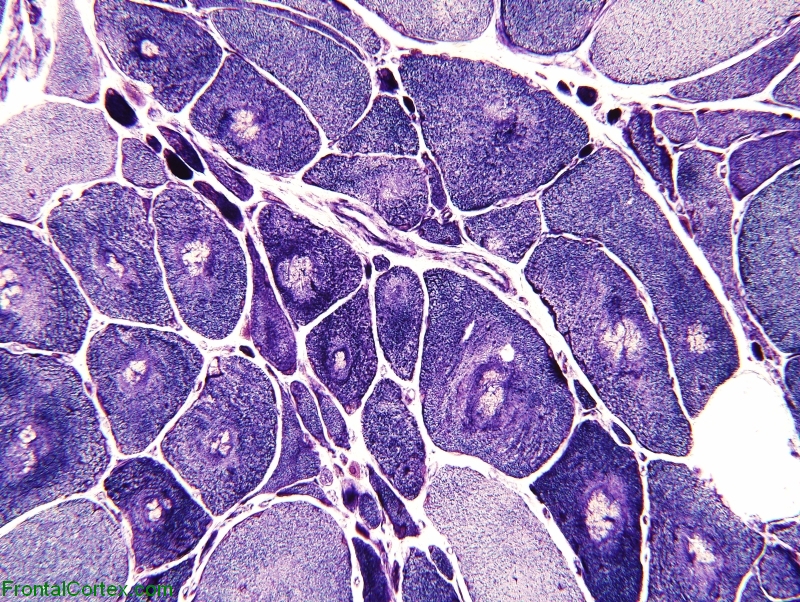 Denervation atrophy of skeletal muscle, NADH-TR